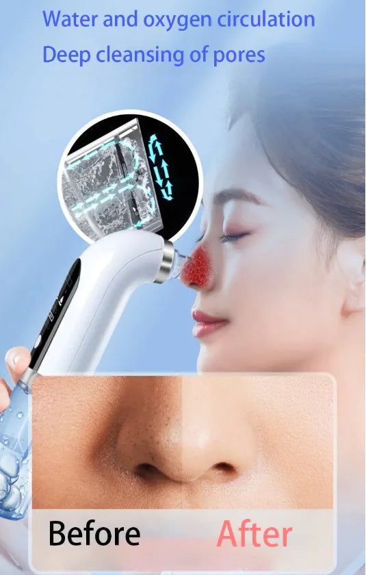 Rechargeable Blackhead Remover Vacuum